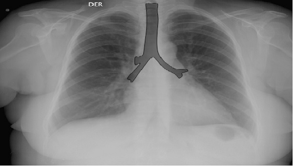 pulmones